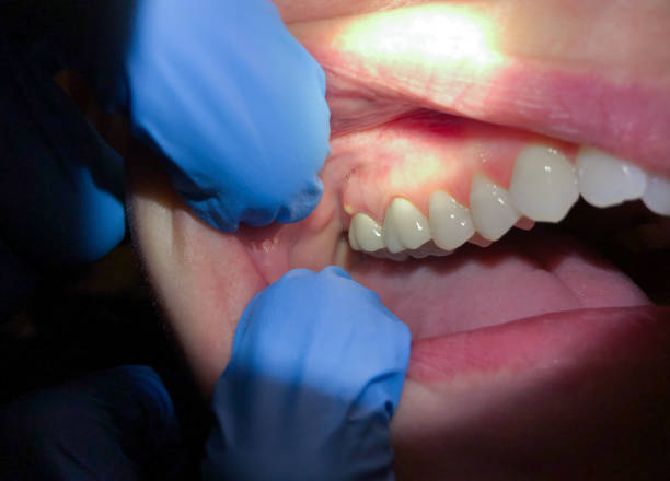 Best Emergency Wisdom Teeth Removal in Goodland, IN